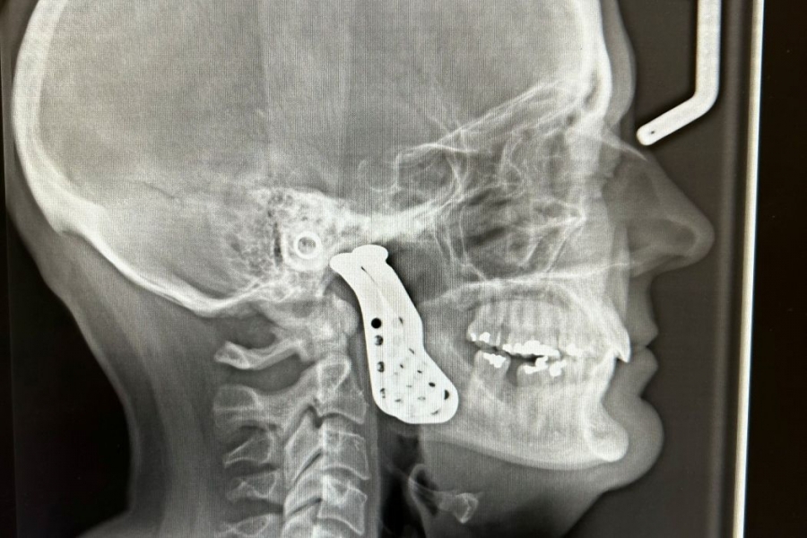 X-ray of head shows the jaw joint replacement. 