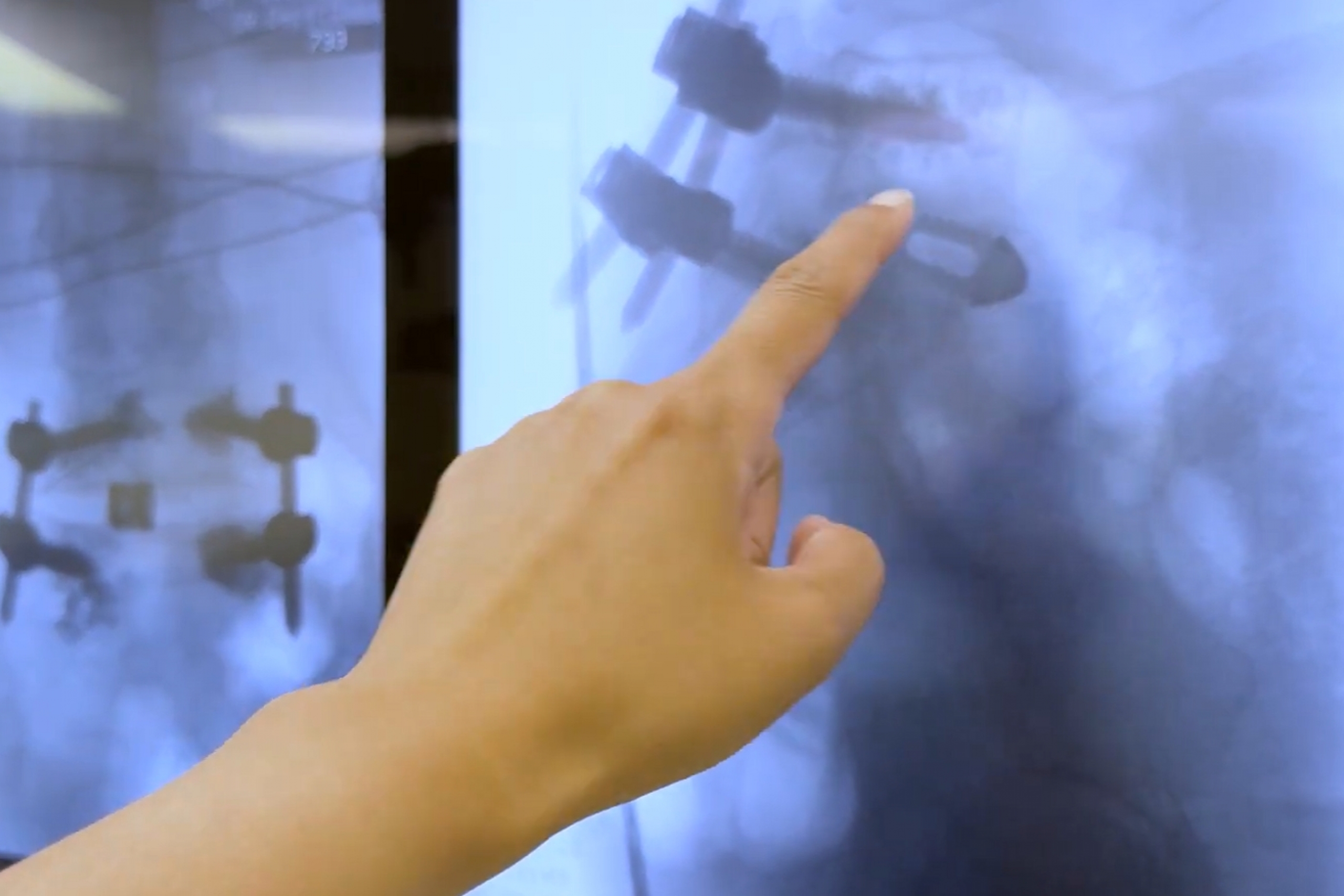 Spinal Xray image